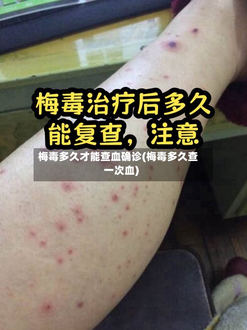 梅毒多久才能查血确诊(梅毒多久查一次血)-第3张图片