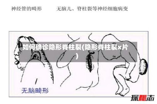 如何确诊隐形脊柱裂(隐形脊柱裂x片)-第3张图片