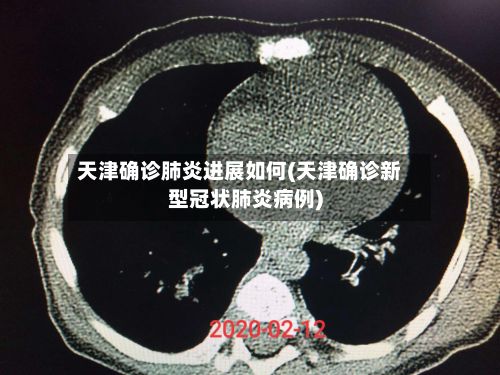 天津确诊肺炎进展如何(天津确诊新型冠状肺炎病例)-第3张图片